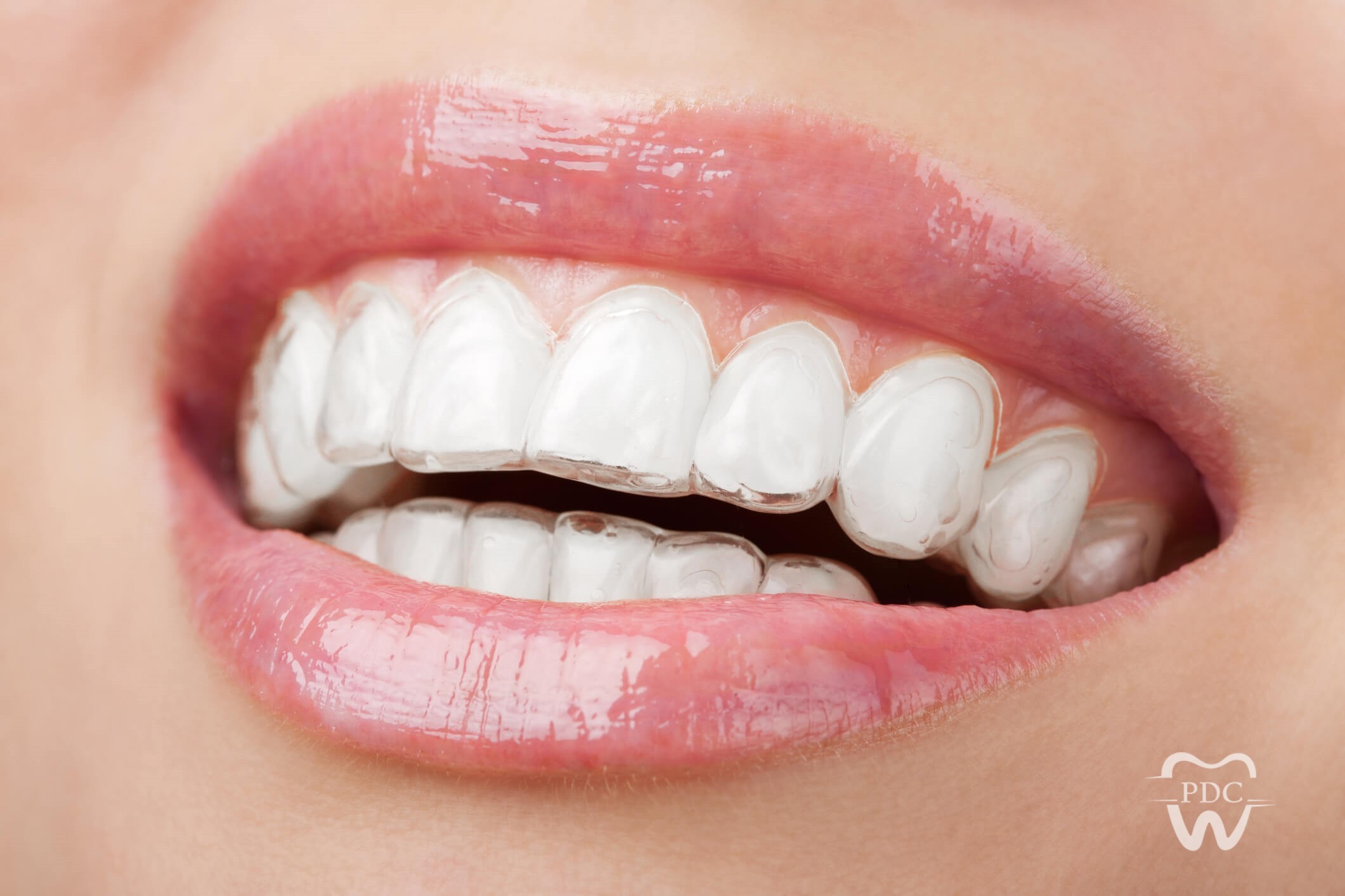 Unlocking the Power of Clear Aligners (INVISALIGN): A Modern Solution to Orthodontic Treatment