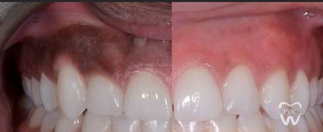 Worried About Dark Gums?